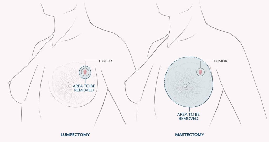 The different breast cancer types. Image extracted from