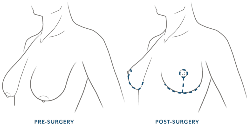Breast Reduction Before and After: The Procedure, Insurance Coverage, and  Recovery