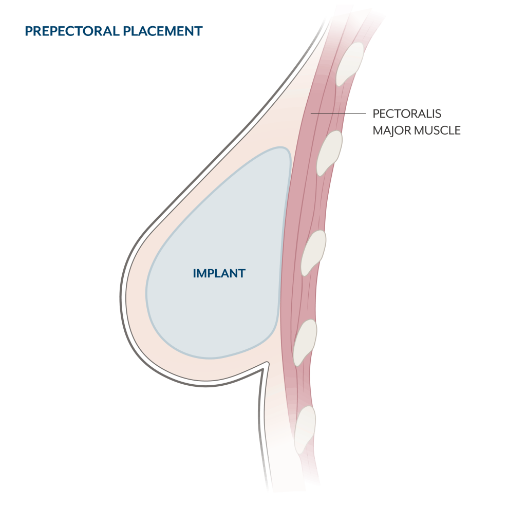 Implant Placement (Above or Below the Muscle) - Friedman Center