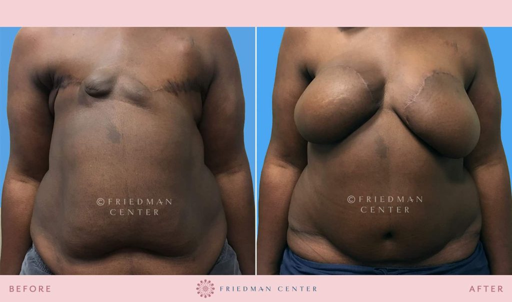 double mastectomy before and after