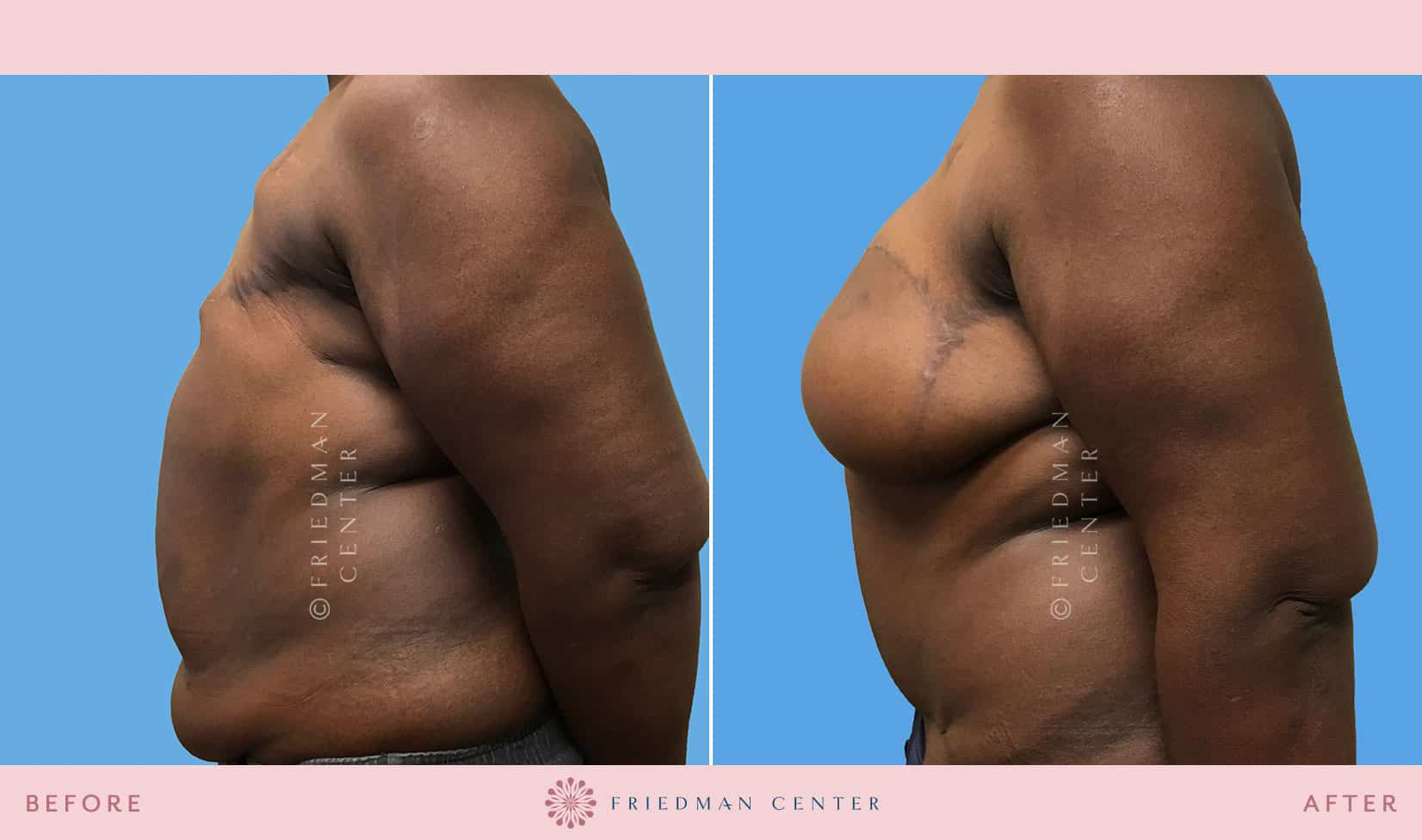 double mastectomy before and after