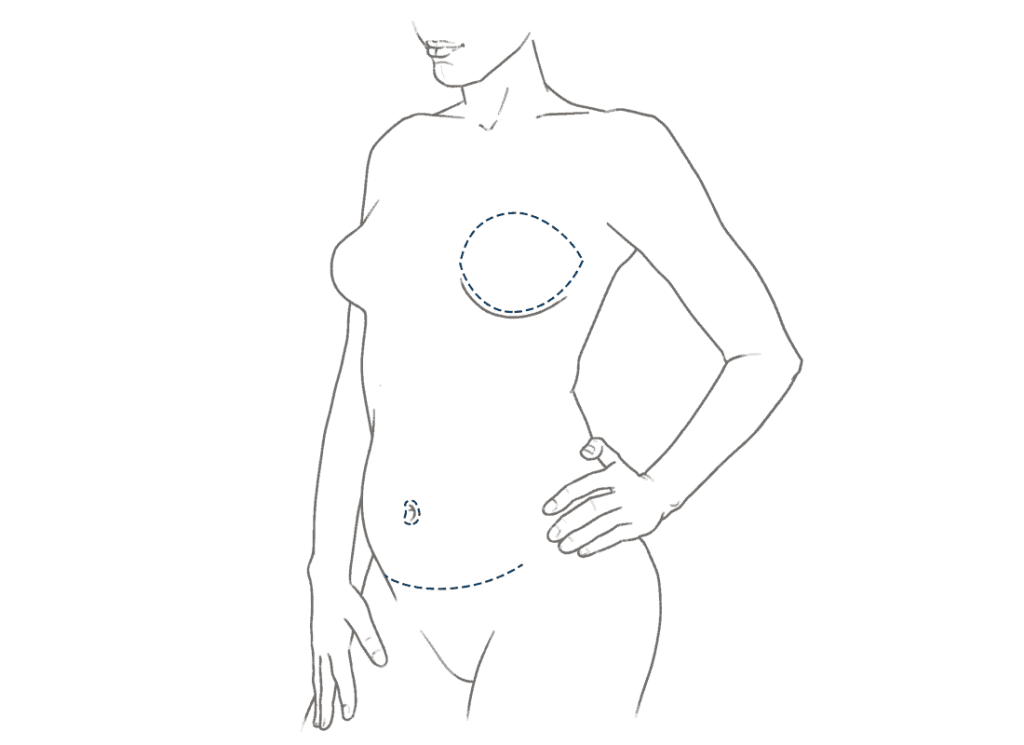 The Aesthetics of the Donor Site: DIEP Flap Breast Reconstruction