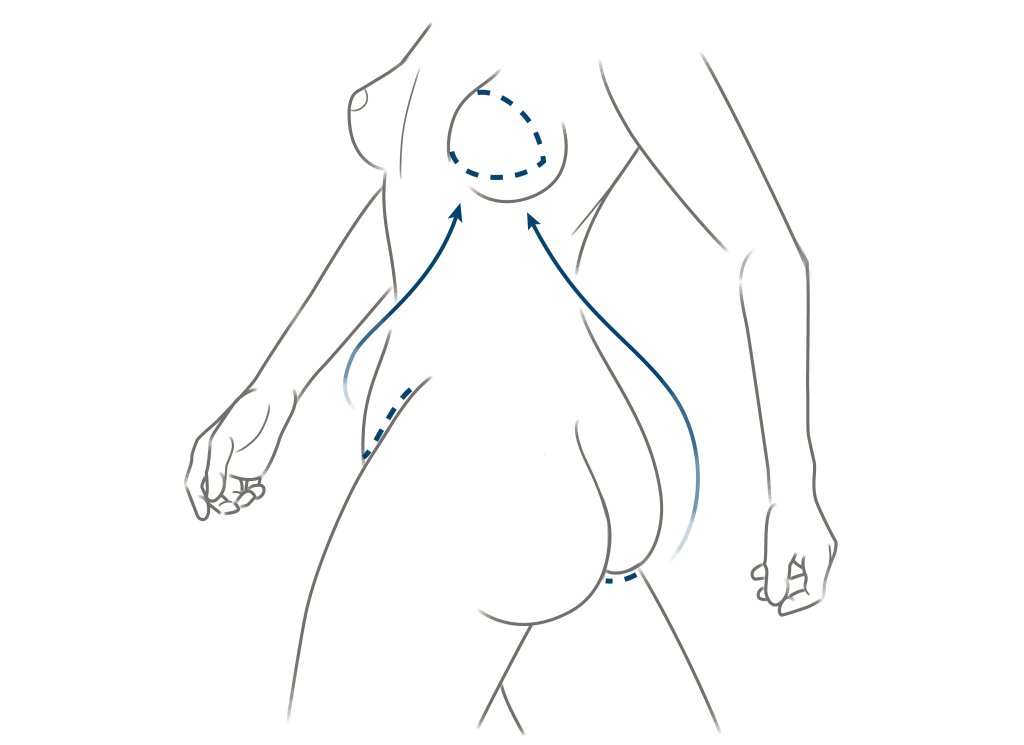 Simultaneous DIEP flap and LAP Flap 