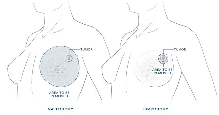 Postoperative view after bilateral prophylactic mastectomy and hybrid