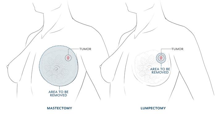 Lumpectomy Before & Afters Patient 01