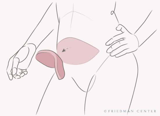 Flap or natural tissue reconstruction - Plastic and Reconstructive