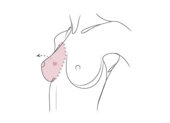 lumpectomy, mastectomy