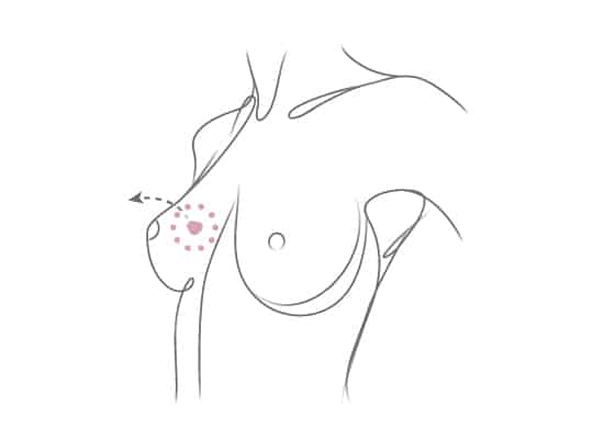 Lumpectomy or Partial Mastectomy, New Attitude Breast Prosthetics