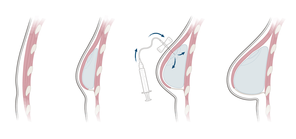 Tissue Expander to Implant Procedure - Friedman Center