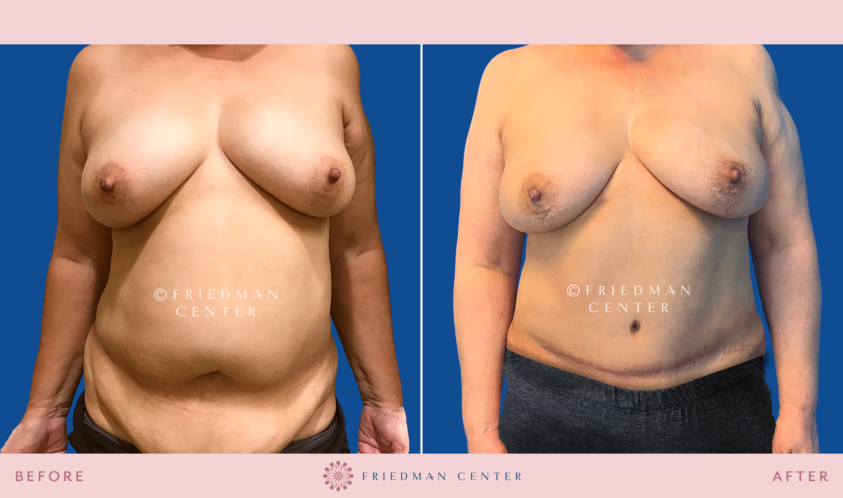 Nipple-Sparing Double Mastectomy - Friedman Center
