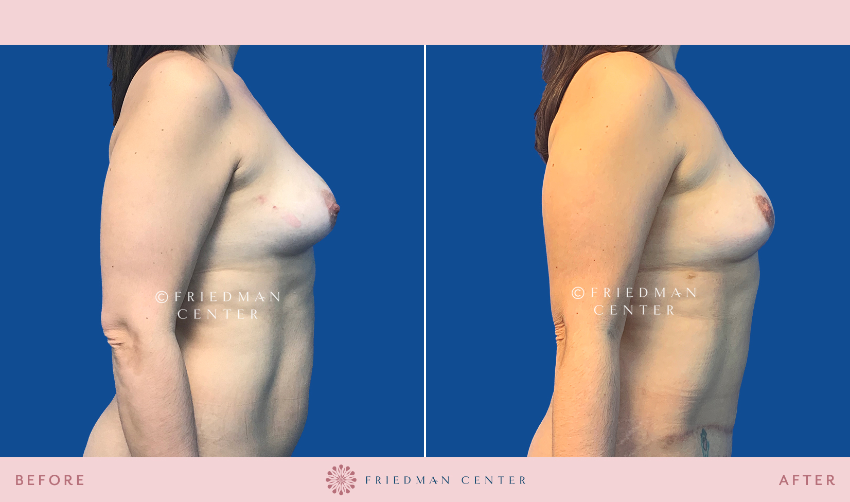 Nipple-Sparing Double Mastectomy - Friedman Center