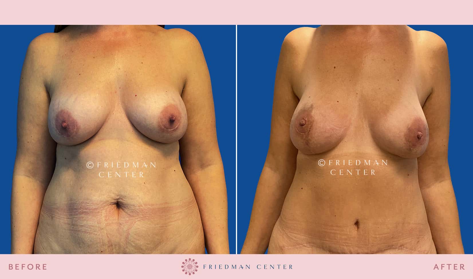 Nipple-Sparing Double Mastectomy - Friedman Center